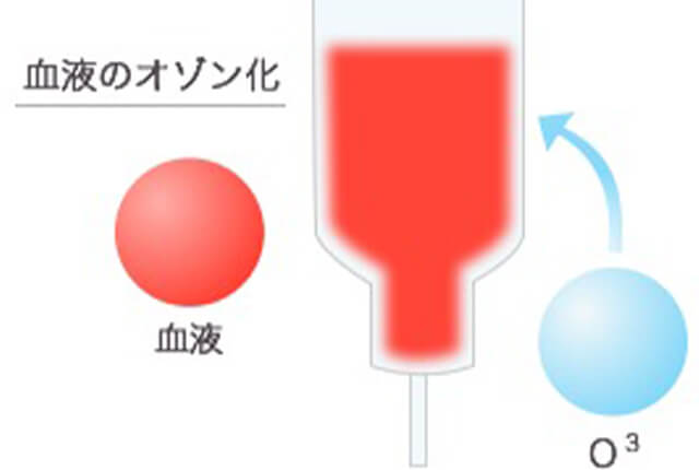 血液オゾン化のイメージイラスト