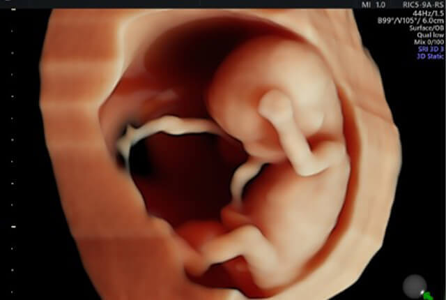 妊娠中の胎児の3D画像